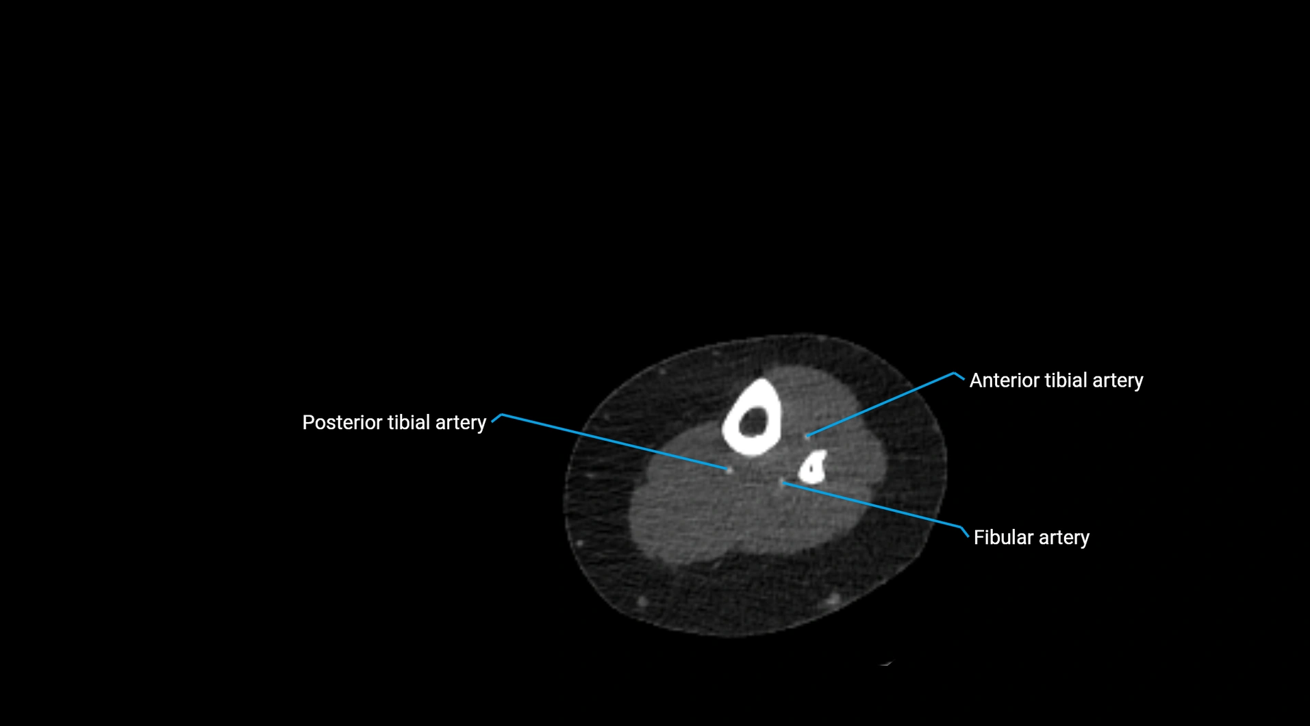 CTA lower limb cross sectional anatomy labelled image _218.webp